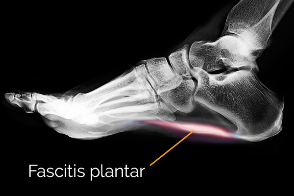 Fascitis plantar